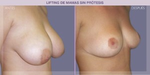 Before and after image of a breast lift procedure.